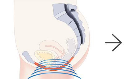 Pelvic Floor Treatment